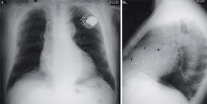 Radiografía de tórax postoperatoria posteroanterior (A) y lateral (B) de un paciente intervenido de reemplazo valvular aórtico. Se aprecia el electrodo epicárdico unipolar en la zona posterolateral de la pared libre del VI (*) y los electrodos endocavitarios de AD y VD (flechas).