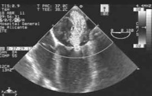Ecocardiograma transesofágico preoperatorio. Insuficiencia mitral grave por restricción en el movimiento del velo posterior de la válvula mitral.