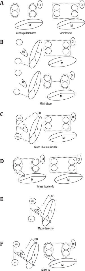 Esquema de los patrones de lesiones quirúrgicas para la ablación de la fibrilación auricular. A. Ablación de venas pulmonares: dos variantes, aislamiento selectivo e independiente de las venas pulmonares, y aislamiento conjunto de las venas pulmonares, izquierdas y derechas, incluyendo la cara posterior de la aurícula izquierda (box lesion). B. MiniMaze: combina un Maze de aurícula izquierda al que se asocia una ablación del istmo cavo-tricuspideo. Existen 2 variantes dependiendo de la forma de aislamiento de las venas pulmonares. C. Maze III: asocia a la exclusión de las venas pulmonares una ablación completa de la aurícula derecha (istmo cavo-tricuspideo, línea de la fosa oval, cresta terminal y de la orejuela derecha hasta válvula tricúspide). D. Maze izquierdo: dos gráficos alternativos para el patrón de Maze izquierdo, dependiendo de la forma del aislamiento de las venas pulmonares. En este patrón no hay asociada ninguna línea en la aurícula derecha. E. Maze derecho: líneas de ablación del istmo cavo-tricuspideo, cresta terminal, orejuela derecha y fosa oval. En este patrón no hay asociada ninguna línea en la aurícula izquierda. F. Maze IV: supone la ablación selectiva e independiente de las venas pulmonares izquierdas y derechas además de una ablación completa de la aurícula derecha. M: válvula mitral. T: válvula tricúspide. OI: orejuela izquierda. FO: fosa oval. VCS: vena cava superior. VCI: vena cava inferior.