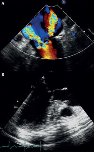 A. Las imágenes ecocardiográficas preoperatorias muestran la insuficiencia mitral grave por prolapso de cuerdas, así como el gradiente en el tracto de salida del ventrículo izquierdo. B. Puede observarse también el contacto del velo mitral anterior contra el septo interventricular.