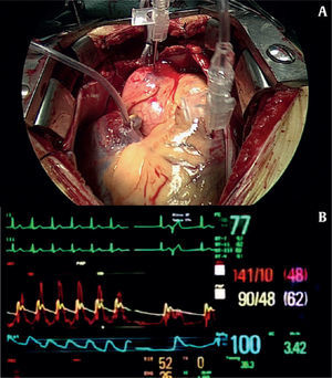 La punción directa de la aorta y del ventrículo izquierdo a través del ventrículo derecho (A) permiten obtener el gradiente de presiones entre ambas cámaras, en reposo y tras provocación de extrasístoles (B).