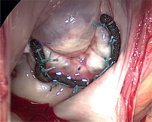 La inspección directa de la válvula mitral muestra correcta coaptación de ambos velos.