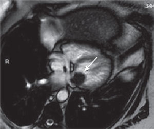 Coronariografía con masa en región basal de ventrículo izquierdo.