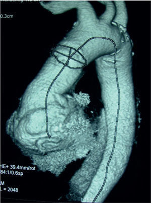 Anulectasia aórtica precirugía de 7cm de diámetro.