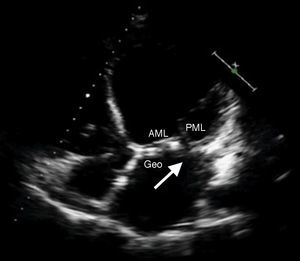 Imagen de ecocardiografía transtorácica en la que se aprecia dehiscencia de la prótesis a nivel posterior del anillo mitral (flecha).