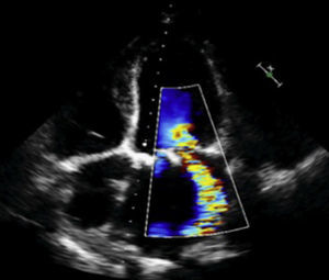 Imagen de ecocardiografía doppler color en la que se observa regurgitación periprotésica severa.