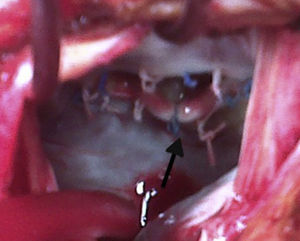Imagen intraoperatoria en la que se observa la dehiscencia en la parte posterior del anillo mitral principalmente a nivel de la joroba (flecha).