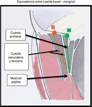 Detalles técnicos del procedimiento de implante de neocuerdas: equivalencia de distancias entre cuerdas marginales y basales.