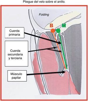 Pliegue (o folding) del velo sobre el anillo.