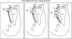 Remodelado del velo durante el implante de neocuerdas. Manejo técnico del exceso de tejido.