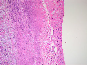 Sarcoma cardiaco teñido con hematoxilina-eosina, ×100.