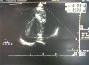 Ecocardiograma que muestra 2 masas en la aurícula derecha.