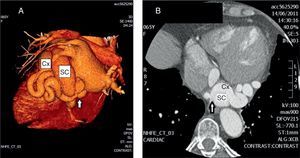 A y B) AngioTAC multidetector. Se aprecia la arteria circunfleja tortuosa, con un aneurisma en su porción media y la fístula a seno coronario (flecha). Cx: arteria circunfleja; SC: seno coronario.