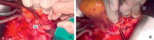 Imágenes quirúrgicas. A) Ligadura de la fístula. B) Aneurisma abierto de la arteria circunfleja. A: aneurisma; F: fístula; SC: seno coronario.