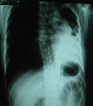 Radiografía posteroanterior de tórax. Atelectasia de lóbulo inferior izquierdo.