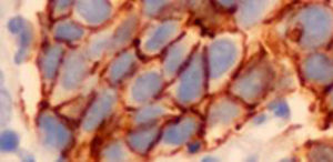 Tinción argéntica. Evidencia de células enterocromafines en el epitelio bronquial.