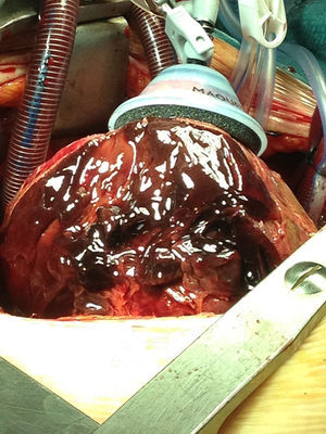 Tras elevar el ápex, se observa la cara inferior de ambos ventrículos con el coágulo adherido a la zona de infarto, la necrosis del miocardio y la fibrina en el resto del epicardio.