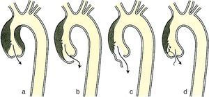 Mecanismos de insuficiencia aórtica en la disección de aorta ascendente.Modificado de Braunwald58.