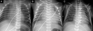 Evolución clínico-radiológica de un drenaje venoso pulmonar anómalo total (DVPAT) a seno coronario no obstructivo + ductus grande. A) Primera semana de vida. B) Segunda semana de vida. Cardiomegalia y plétora importantes al comenzar a disminuir las resistencias vasculares pulmonares. C) Radiografía postoperatoria, con la paciente ya extubada, habiendo mejorado la cardiomegalia y la plétora pulmonar.