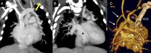 TC de un drenaje mixto. A) La flecha muestra la vena pulmonar superior izquierda drenando mediante una vena vertical en la vena innominada. B) El asterisco muestra el colector que recoge el resto de venas pulmonares. C) Reconstrucción 3D, visión posterior, sin la aorta torácica descendente. La vena pulmonar superior izquierda desagua en la vena innominada. Las otras 3 venas pulmonares, señaladas con flechas cortas, confluyen en un colector (asterisco) que desemboca en el seno coronario.