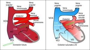 Esquema de la reparación de un DVPAT supracardíaco. A la izquierda, situación prequirúrgica. A la derecha, situación tras la reparación. Cortesía del Dr. Villagrá.