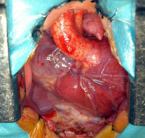 Imagen intraoperatoria de L-TGA (S, L, L).