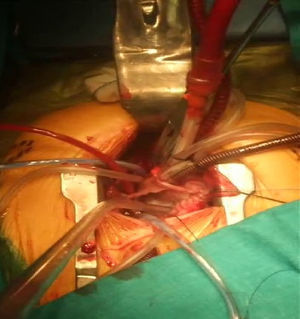 Imagen intraoperatoria de un paciente sometido a cierre de CIA y CIV mediante miniesternotomía inferior.