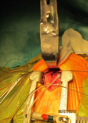 Imagen intraoperatoria de un implante de marcapasos epicárdico por miniestertomía inferior.