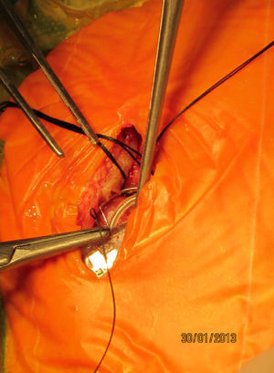 Imagen intraoperatoria en el mismo paciente.