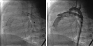 Stents en el ductus y el tracto de salida derecho (proyección lateral izquierda).