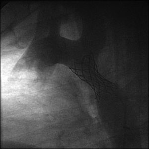 Colocación de stent en la zona de coartación aórtica.