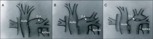Tipos de interrupción del arco aórtico. En el tipo A, la interrupción se sitúa tras la salida de la arteria subclavia izquierda. En el tipo B se sitúa entre las arterias carótida y subclavia izquierdas. El tipo C presenta una interrupción del arco aórtico tras la salida del tronco braquiocefálico. AoAs: aorta ascendente; AoDes: aorta descendente; D.A.: ductus arterioso.