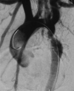 Imagen de coartación nativa distal a la subclavia izquierda en un adolescente, obtenida mediante angiografía, con catéter en el interior de la aorta para tratamiento intervencionista.