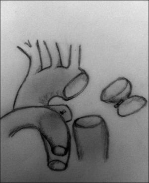 Imagen de aorta descendente con la zona de coartación movilizada y resecada, y el ductus arterioso ligado.