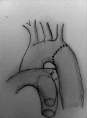 Tras la resección de la zona de coartación y la movilización extensa de la aorta descendente y el arco aórtico, se realiza una anastomosis término-terminal, que elimina el estrechamiento.