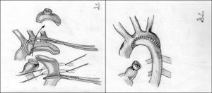 Anastomosis término-terminal extendida, que elimina la zona de coartación y la hipoplasia del istmo aórtico.