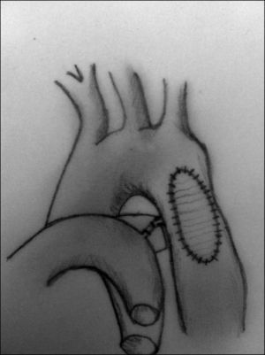 Técnica de aortoplastia con parche. Esta técnica necesita menor movilización aórtica, aunque no elimina la zona de tejido ductal.