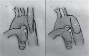 Técnica de Waldhause (aortoplastia con flap de subclavia). A) Se puede observar la aorta descendente y la arteria subclavia izquierda abiertas longitudinalmente. Posteriormente, se secciona la arteria subclavia. B) Se desliza sobre la aorta sobrepasando la zona de la coartación ampliando esta. DA: ductus arterioso; S.I.: arteria subclavia izquierda.