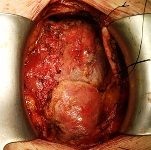 Imagen intraoperatoria de seudoaneurisma contenido en aorta ascendente.