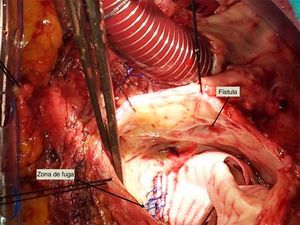 Seudoaneurisma abierto donde se visualiza zona de fuga de la anastomosis de cirugía previa así como orificio de fístula a aurícula derecha.