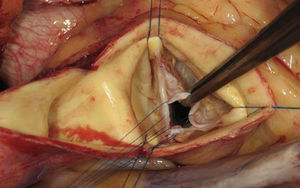 Las suturas de tracción a través de los bordes libres de los 2 velos se colocan de modo que la distancia a la comisura debe ser idéntica, lo que nos permite objetivar el tejido redundante del velo que debe ser eliminado.