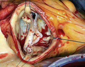 En la válvula aórtica bicúspide, se debe tener en cuenta la orientación variable de las comisuras en el momento de colocar las suturas comisurales.