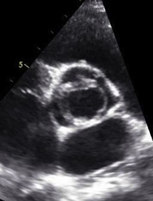 Ecocardiografía transesofágica, eje corto. Patrón de abertura excéntrica típica de una válvula aórtica unicúspide.