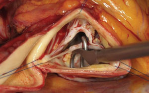 Válvula aórtica bicúspide. Medición de la altura efectiva del velo no coronario (velo no fusionado) mediante un pie de rey.