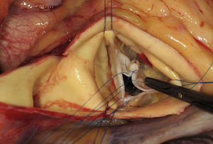 Corrección de un prolapso del velo coronario derecho de una válvula tricúspide mediante plicatura central con suturas. Las suturas se inician en el borde libre y, de acuerdo con la configuración del velo, se extienden en sentido caudal.