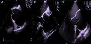 Formas anátomo-clínicas de dilatación de la aorta ascendente de la raíz aórtica en eje largo de aorta medioesofágico en ecocardiografía transesofágica A) Dilatación de aorta supratubular. B) Dilatación de senos de Valsalva o raíz aórtica. C) Anuloectasia aórtica.