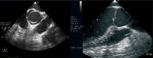 Ecocardiografía transesofágica en eje corto de válvula aórtica bicúspide tipo 1. Dos velos sin rafe, con 2 senos de Valsalva y sin fusión comisural. En eje largo, prolapso de uno de los velos en el tracto de salida VI.