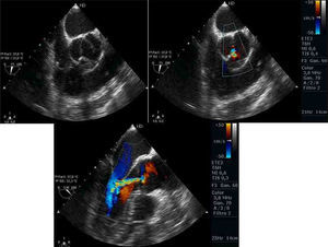 Ecocardiografía transesofágica de una válvula aórtica bicúspide tipo 2 en eje corto y eje largo, bidimensional y con Doppler color. Existe un rafe fibroso y parcialmente calcificado en la fusión entre los velos coronario derecho y no coronario, 3 senos de Valsalva. Existe un déficit de coaptación central de los velos por restricción en el movimiento secundaria a la fibrosis del rafe.