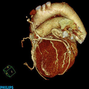 Imagen de angio-TAC coronaria. Se visualiza injerto de arteria mamaria izquierda a descendente anterior e injerto secuencial de radial en «T» a oblicua marginal y descendente posterior.