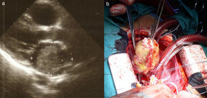 a) Tumor de aurícula izquierda. b) Exéresis completa con su base de implantación.